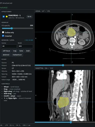 The viewer showing an abdominal CT in axial, coronal and sagittal planes, the pancreas contour filled yellow in each, beside the structure, window and study panels.