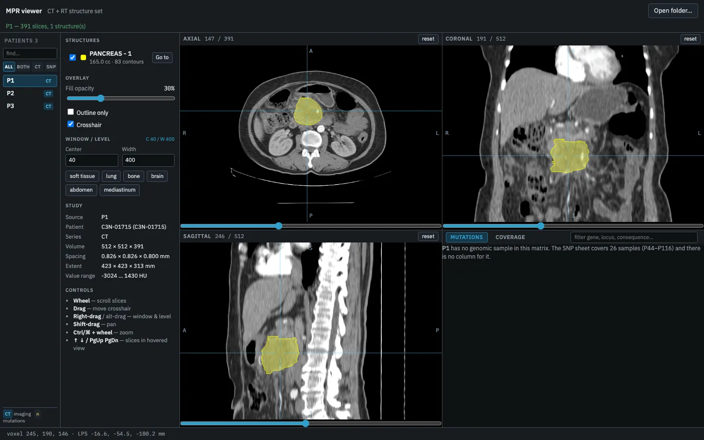 The viewer showing an abdominal CT in axial, coronal and sagittal planes, the pancreas contour filled yellow in each, beside the structure, window and study panels.